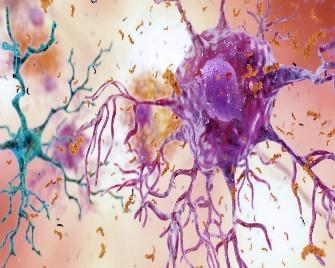 Alzheimer's Disease illustration 1