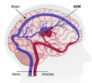 AVM Surgery illustration 1