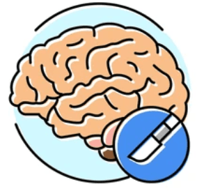 AVM Surgery illustration 2