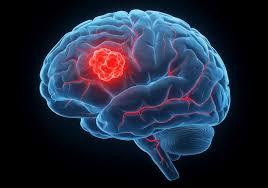 Brain Tumour illustration 1