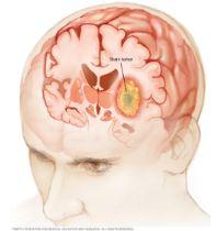Brain Tumour Surgery illustration 1