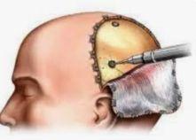 Burr Hole Surgery illustration 2