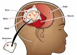 Craniotomy illustration 1