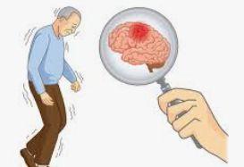 Deep Brain Stimulation illustration 1