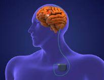 Deep Brain Stimulation illustration 2