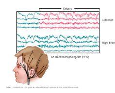 Electroencephalogram (EEG) illustration 2