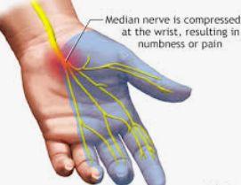 Electromyography (EMG) illustration 1