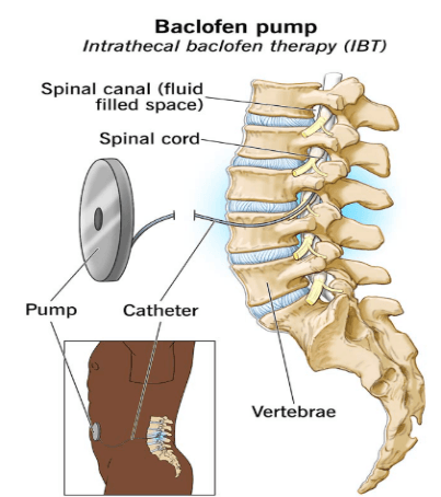 Intrathecal Baclofen Pump illustration 2