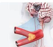 Mechanical Thrombectomy illustration 1