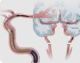 Mechanical Thrombectomy illustration 2