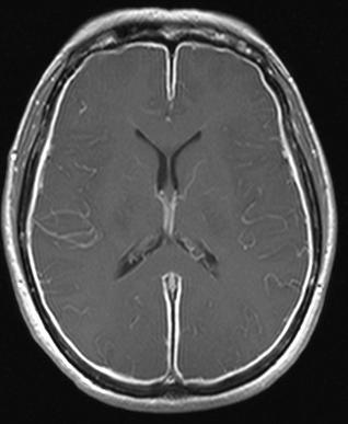 Meningitis illustration 1