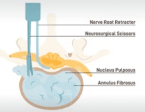Microdiscectomy illustration 1