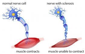 Multiple Sclerosis illustration 1