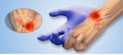 Nerve Conduction Study (NCS) illustration 1