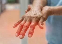 Peripheral Neuropathy illustration 1