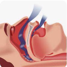 Polysomnography (Sleep Study) illustration 1