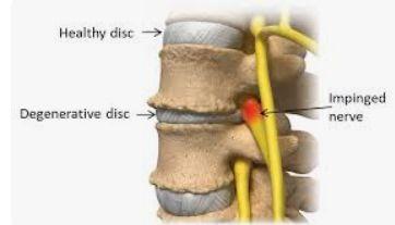 Spinal Fusion Surgery illustration 1