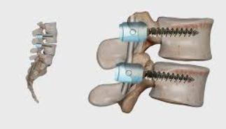 Spinal Fusion Surgery illustration 2
