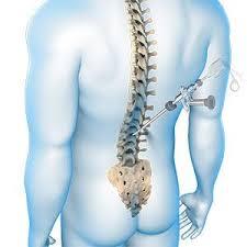 Spine Surgeries illustration 1