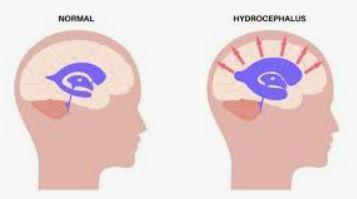 Ventriculoperitoneal (VP) Shunt Surgery illustration 1