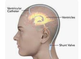 Ventriculoperitoneal (VP) Shunt Surgery illustration 2