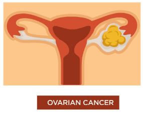 Hysterectomy & Ovarian Cancer Surgery illustration 3