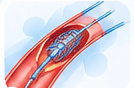 Angioplasty Package