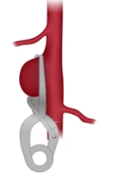 Aneurysm Clipping illustration 2