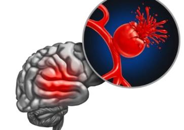 Aneurysm Coiling illustration 1