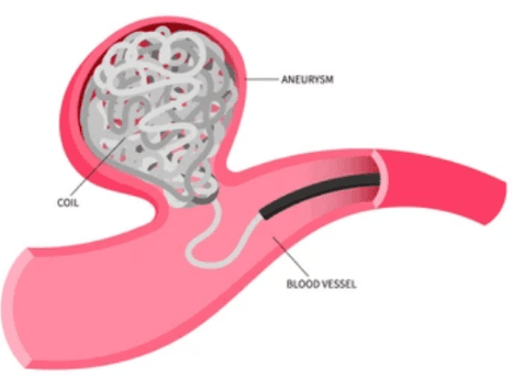 Aneurysm Coiling illustration 2