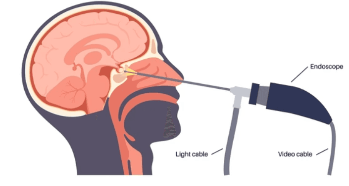 Endoscopic Brain Surgery illustration 1