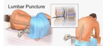 Lumbar Puncture illustration 2
