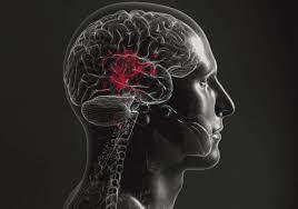 Stroke illustration 1