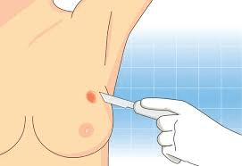 Breast Conserving Surgery (BCS) illustration 2