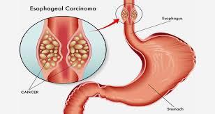 Esophageal Cancer illustration 1