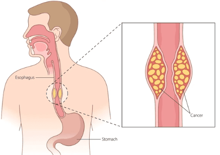 Esophagectomy illustration 1