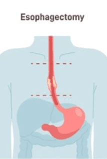 Esophagectomy illustration 2
