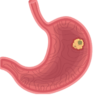 Gastrointestinal Cancer Surgery illustration 2