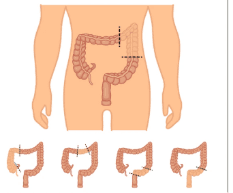 Gastrointestinal Cancer Surgery illustration 3
