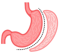 Gastrointestinal Cancer Surgery illustration 4