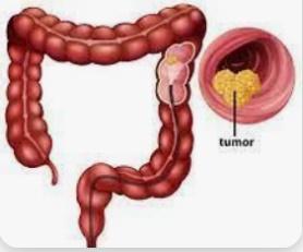 Laparoscopic Cancer Surgery illustration 1