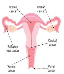 Laparoscopic Cancer Surgery illustration 2