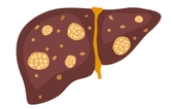 Liver Resection illustration 1
