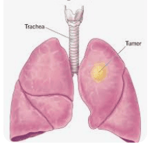 Lung Lobectomy illustration 1