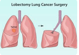 Lung Lobectomy illustration 2