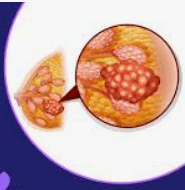 Oncoplastic Breast Reconstruction illustration 1