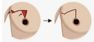 Oncoplastic Breast Reconstruction illustration 2