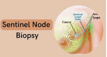Sentinel Lymph Node Biopsy (SLNB) illustration 2