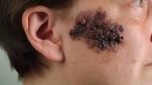 Skin Cancer illustration 1