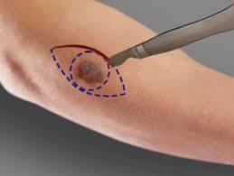 Skin Cancer illustration 2